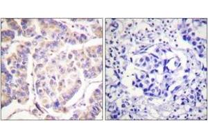 Immunohistochemistry analysis of paraffin-embedded human breast carcinoma tissue, using SYK (Ab-525) Antibody. (SYK Antikörper  (AA 491-540))