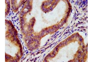IHC image of ABIN7160339 diluted at 1:300 and staining in paraffin-embedded human endometrial cancer performed on a Leica BondTM system. (MEGF9 Antikörper  (AA 49-178))