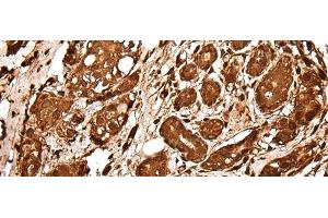 Immunohistochemistry of paraffin-embedded Human breast cancer tissue using VCP Polyclonal Antibody at dilution of 1:30(x200) (VCP Antikörper)