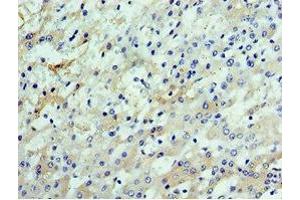 Immunohistochemistry of paraffin-embedded human liver cancer using ABIN7147929 at dilution of 1:100 (CSTF2 Antikörper  (AA 1-180))