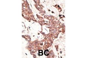 Formalin-fixed and paraffin-embedded human cancer tissue reacted with the primary antibody, which was peroxidase-conjugated to the secondary antibody, followed by AEC staining. (SIRT3 Antikörper  (C-Term))