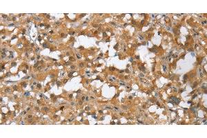 Immunohistochemistry of paraffin-embedded Human thyroid cancer tissue using MMP12 Polyclonal Antibody at dilution of 1:60 (MMP12 Antikörper)