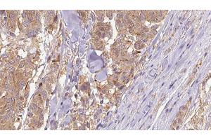 ABIN6266830 at 1/100 staining Human Melanoma tissue by IHC-P. (COL4A1 Antikörper)