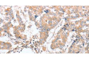 Immunohistochemistry of paraffin-embedded Human breast cancer tissue using PARD6A Polyclonal Antibody at dilution 1:60 (PARD6A Antikörper)