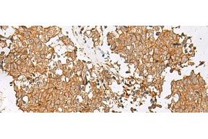 Immunohistochemistry of paraffin-embedded Human lung cancer tissue using GSTM2 Polyclonal Antibody at dilution of 1:50(x200) (GSTM2 Antikörper)