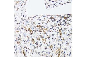 Immunohistochemistry of paraffin-embedded human uterine cancer using DHRS2 antibody. (DHRS2 Antikörper  (AA 1-300))