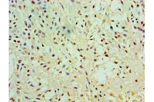 Immunohistochemistry of paraffin-embedded human breast cancer using ABIN7151444 at dilution of 1:100 (PHD1 Antikörper  (AA 283-407))