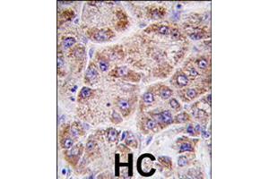 Formalin-fixed and paraffin-embedded human hepatocellular carcinoma reacted with FDPS polyclonal antibody  , which was peroxidase-conjugated to the secondary antibody, followed by DAB staining . (FDPS Antikörper  (AA 338-453))