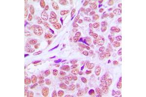 Immunohistochemical analysis of PCAF staining in human breast cancer formalin fixed paraffin embedded tissue section. (KAT2B Antikörper  (C-Term))