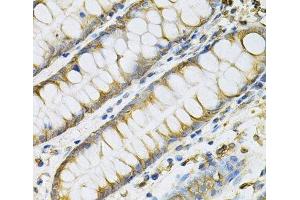 Immunohistochemistry of paraffin-embedded Human colon using PDGFB Polyclonal Antibody at dilution of 1:100 (40x lens). (PDGFB Antikörper)
