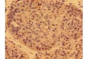 Immunohistochemistry of paraffin-embedded human liver cancer using ABIN7162766 at dilution of 1:100 (GDF15 Antikörper  (AA 16-143))