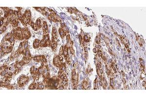 ABIN6278311 at 1/100 staining Human liver cancer tissue by IHC-P. (ITGA6 Antikörper  (N-Term))