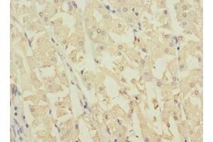 Immunohistochemistry of paraffin-embedded human gastric cancer using ABIN7162039 at dilution of 1:100 (NME3 Antikörper  (AA 20-169))