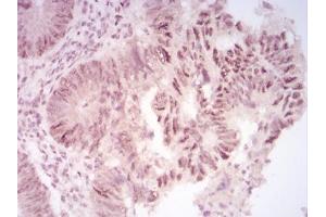 Immunohistochemical analysis of paraffin-embedded rectum cancer tissues using CBX2 mouse mAb with DAB staining. (CBX2 Antikörper  (AA 402-525))