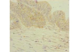 Immunohistochemistry of paraffin-embedded human colon cancer using ABIN7154305 at dilution of 1:100 (GORASP2 Antikörper  (AA 353-452))