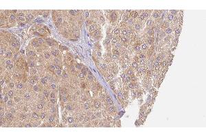 ABIN6277537 at 1/100 staining Human Melanoma tissue by IHC-P. (LUM Antikörper  (N-Term))