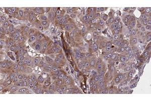 ABIN6273609 at 1/100 staining Human liver cancer tissue by IHC-P. (BIN2 Antikörper  (Internal Region))