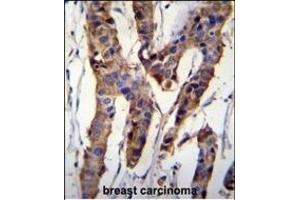 ZBT24 Antibody (N-term) (ABIN655829 and ABIN2845247) immunohistochemistry analysis in formalin fixed and paraffin embedded human breast carcinoma followed by peroxidase conjugation of the secondary antibody and DAB staining. (ZBTB24 Antikörper  (N-Term))