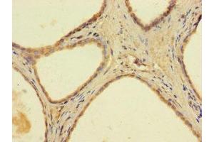 Immunohistochemistry of paraffin-embedded human prostate cancer using ABIN7144667 at dilution of 1:100 (AADAC Antikörper  (AA 24-399))