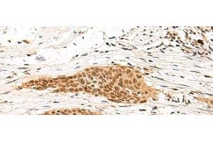 Immunohistochemistry of paraffin-embedded Human esophagus cancer tissue using MDFI Polyclonal Antibody at dilution of 1:55(x200) (MDFI Antikörper)