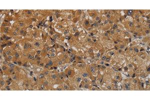 Immunohistochemistry of paraffin-embedded Human liver cancer tissue using TAB1 Polyclonal Antibody at dilution 1:40 (TAB1 Antikörper)
