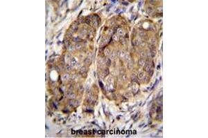 METTL2 Antibody (C-term) immunohistochemistry analysis in formalin fixed and paraffin embedded human breast carcinoma followed by peroxidase conjugation of the secondary antibody and DAB staining. (METTL2 Antikörper  (C-Term))