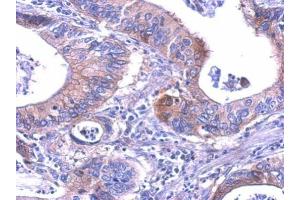 IHC-P Image LDH-B antibody detects LDHB protein at cytosol on human gastric cancer by immunohistochemical analysis.