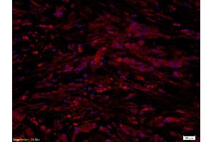 Formalin-fixed and paraffin embedded human gastric cancer labeled with Anti-UCP-1 Polyclonal Antibody, Unconjugated (ABIN675413) at 1:300 followed by conjugation to the secondary antibody and DAPI staining (UCP1 Antikörper  (AA 101-200))