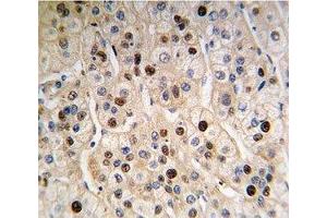 IHC analysis of FFPE human hepatocarcinoma tissue stained with anti-PCNA antibody (PCNA Antikörper  (AA 89-117))