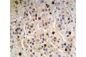 IHC analysis of FFPE human hepatocarcinoma tissue stained with anti-PCNA antibody