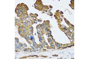 Immunohistochemistry of paraffin-embedded human colon carcinoma using SLC25A13 antibody. (slc25a13 Antikörper  (AA 1-300))
