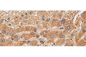 Immunohistochemistry of paraffin-embedded Human liver cancer tissue using PDHA1 Polyclonal Antibody at dilution of 1:50(x200) (PDHA1 Antikörper)