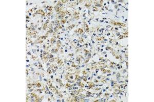 Immunohistochemistry of paraffin-embedded human uterine cancer using TXN2 antibody.