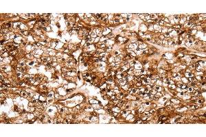 Immunohistochemistry of paraffin-embedded Human renal cancer tissue using SLC9A3R2 Polyclonal Antibody at dilution 1:40 (SLC9A3R2 Antikörper)