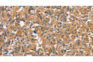 Immunohistochemistry of paraffin-embedded Human thyroid cancer using DNM2 Polyclonal Antibody at dilution of 1:40 (DNM2 Antikörper)
