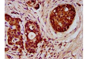 IHC image of ABIN7152390 diluted at 1:300 and staining in paraffin-embedded human pancreatic cancer performed on a Leica BondTM system. (FCHO1 Antikörper  (AA 45-180))