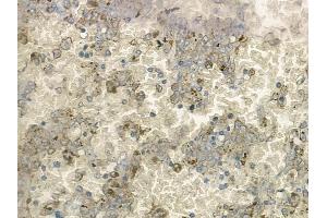 ABIN6260931 and ABIN6272277 at 1/100 staining human melanoma by IHC-P.
