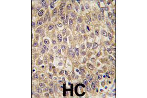 Formalin-fixed and paraffin-embedded human hepatocellular carcinoma reacted with AFP polyclonal antibody  , which was peroxidase-conjugated to the secondary antibody, followed by DAB staining. (alpha Fetoprotein Antikörper  (N-Term))