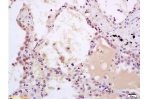 Formalin-fixed and paraffin embedded human lung carcinoma labeled with Rabbit Anti phospho-SHC(Tyr239/240) Polyclonal Antibody, Unconjugated (ABIN745973) at 1:200 followed by conjugation to the secondary antibody and DAB staining (SHC1 Antikörper  (pTyr349, pTyr350))