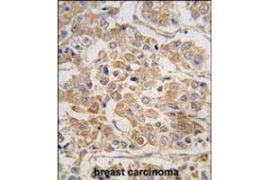 Formalin-fixed and paraffin-embedded human breast carcinoma tissue reacted with IKKE Antibody (C-term) (ABIN392751 and ABIN2842204) , which was peroxidase-conjugated to the secondary antibody, followed by DAB staining. (IKKi/IKKe Antikörper  (C-Term))