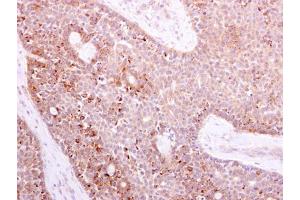 IHC-P Image NOX1 antibody detects NOX1 protein at cytoplasm on human lung carcinoma by immunohistochemical analysis. (NOX1 Antikörper)