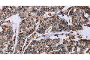 Immunohistochemistry of paraffin-embedded Human breast cancer tissue using DDX11 Polyclonal Antibody at dilution 1:30 (DDX11 Antikörper)