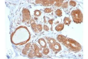 Formalin-fixed, paraffin-embedded human Breast Carcinoma stained with STAT5B Mouse Monoclonal Antibody (STAT5B/2611). (STAT5B Antikörper)