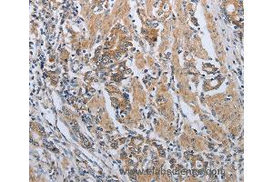 Immunohistochemistry of Human lung cancer using PDCD1 Polyclonal Antibody at dilution of 1:50 (PD-1 Antikörper)