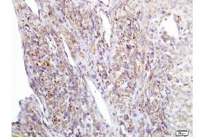 Formalin-fixed and paraffin embedded human cervical carcinoma labeled with Anti APE/Girdin Polyclonal Antibody, Unconjugated  at 1:200 followed by conjugation to the secondary antibody and DAB staining (Girdin Antikörper  (AA 1401-1500))