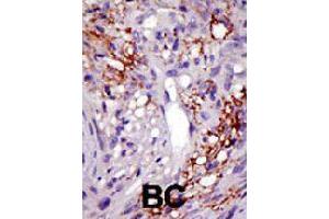 Formalin-fixed and paraffin-embedded human cancer tissue reacted with USP22 polyclonal antibody  , which was peroxidase-conjugated to the secondary antibody, followed by DAB staining . (USP22 Antikörper  (C-Term))