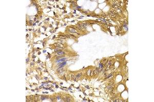Immunohistochemistry of paraffin-embedded human colon cancer using IRF6 antibody at dilution of 1:200 (400x lens).