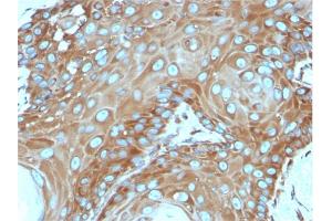 Formalin-fixed, paraffin-embedded human Basal Cell Carcinoma stained with Laminin Receptor Monospecific Mouse Monoclonal Antibody (RPSA/2699). (RPSA/Laminin Receptor Antikörper)