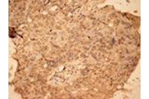 Immunohistochemistry analysis of human lung cancer tissue with PKC pAb.