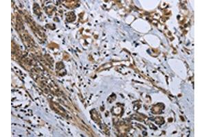 The image on the left is immunohistochemistry of paraffin-embedded Human breast cancer tissue using ABIN7129587(GDF3 Antibody) at dilution 1/25, on the right is treated with fusion protein. (GDF3 Antikörper)